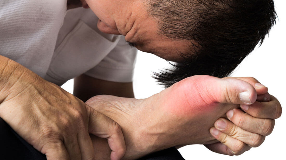 Gout can affect your sexual health and performance