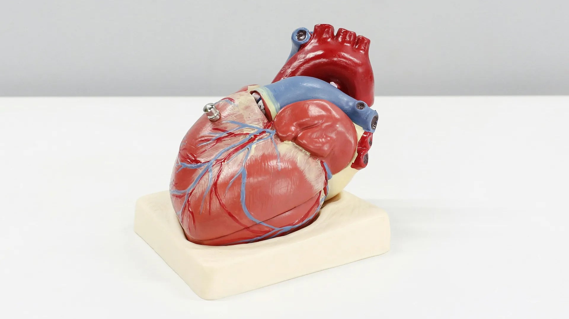 Cardiomegaly - enlarged heart