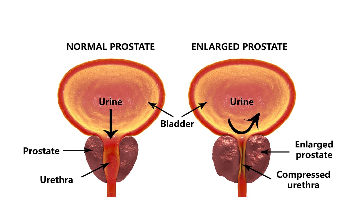 Enlarged Prostate