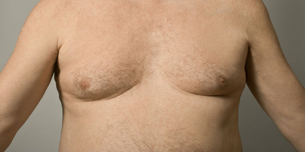 Gynecomastia is a uniquely male problem